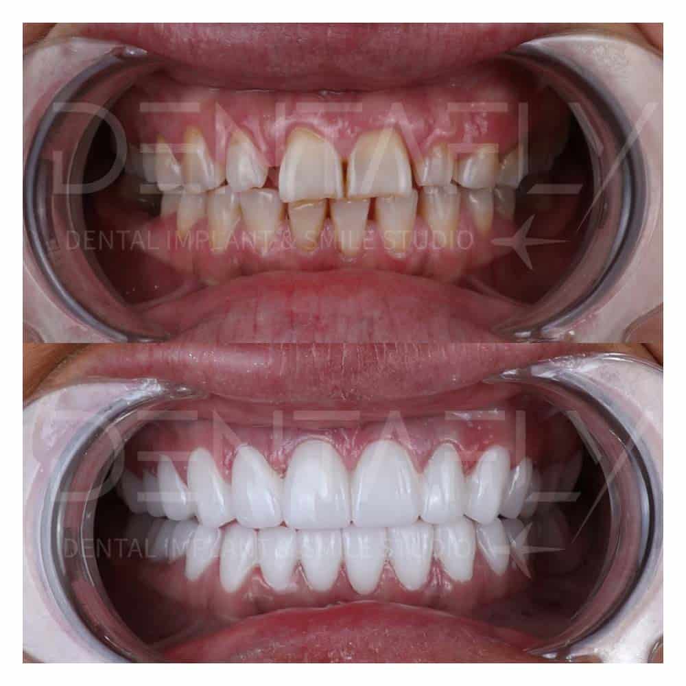 turkey-teeth-before-after-gallery-5