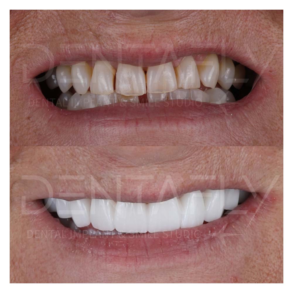 turkey-teeth-before-after-gallery-6