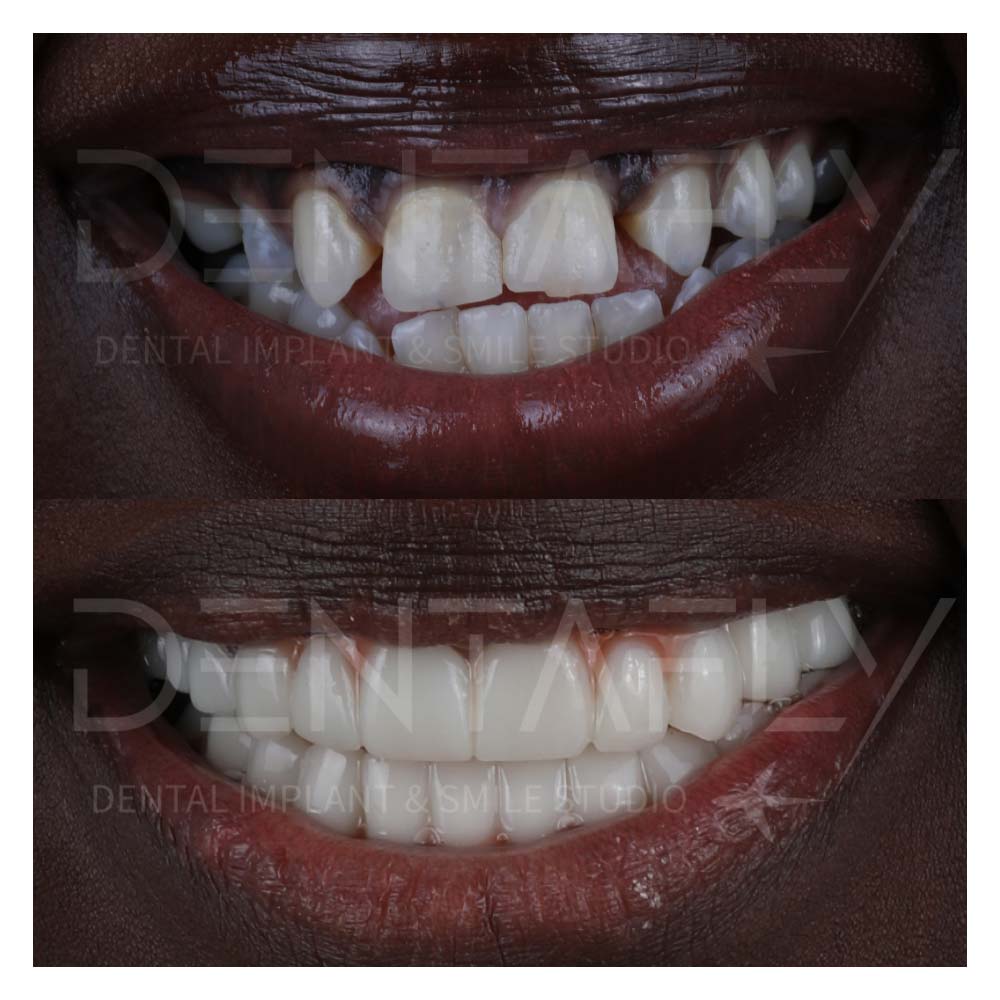 turkey-teeth-before-after-gallery-7