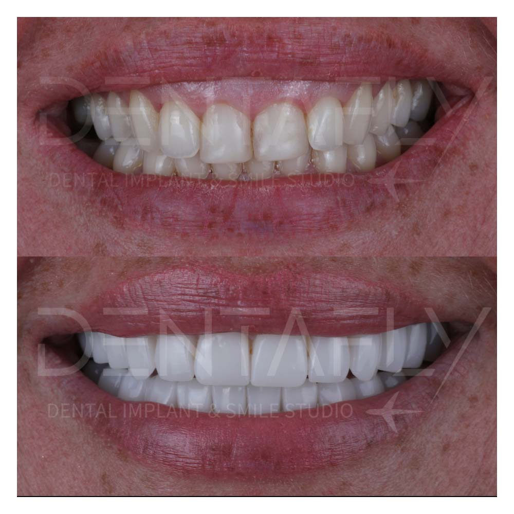 turkey-teeth-before-after-gallery-8