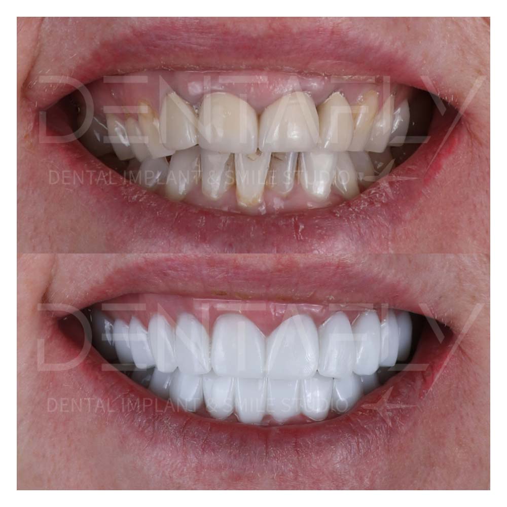 turkey-teeth-before-after-gallery-9