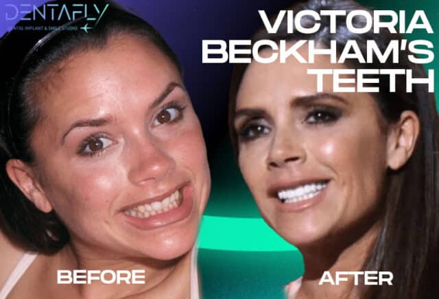 Victoria Beckham Teeth Before and After