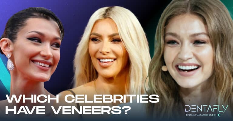 which celebrities have veneers