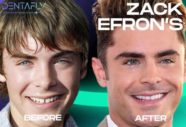 Zac Efron Before After