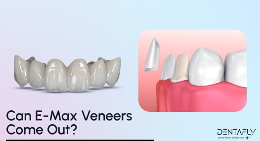 Can-E-Max-Veneers-Come-Out