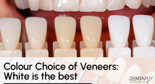 Colour-Choice-of-Veneers-White-is-the-best