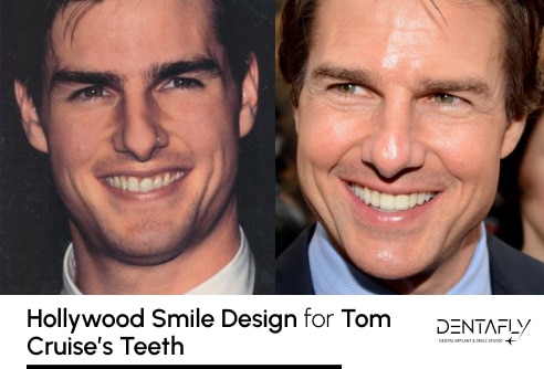 Hollywood Smile Design for Tom Cruise