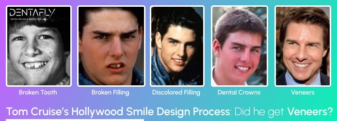 Tom Cruise's Teeth Timeline