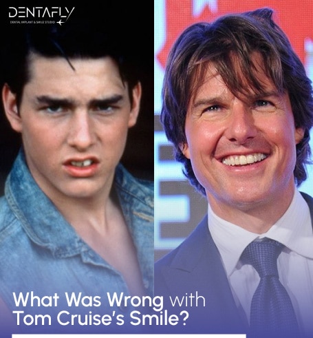 Tom Cruise got which treatment