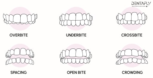 Under Bite vs Over Bite dental care