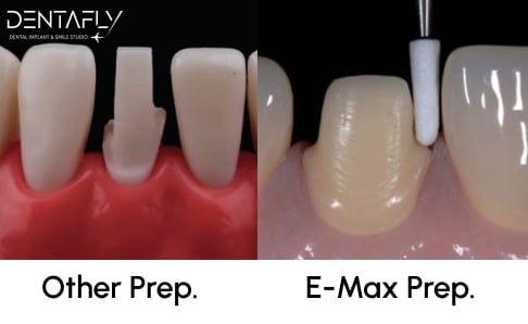 other-preps-vs-e-max-prep