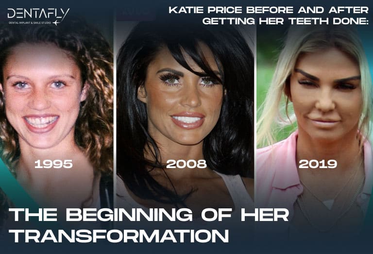 Katie Price’s Teeth: Dental Aesthetic Celebrity