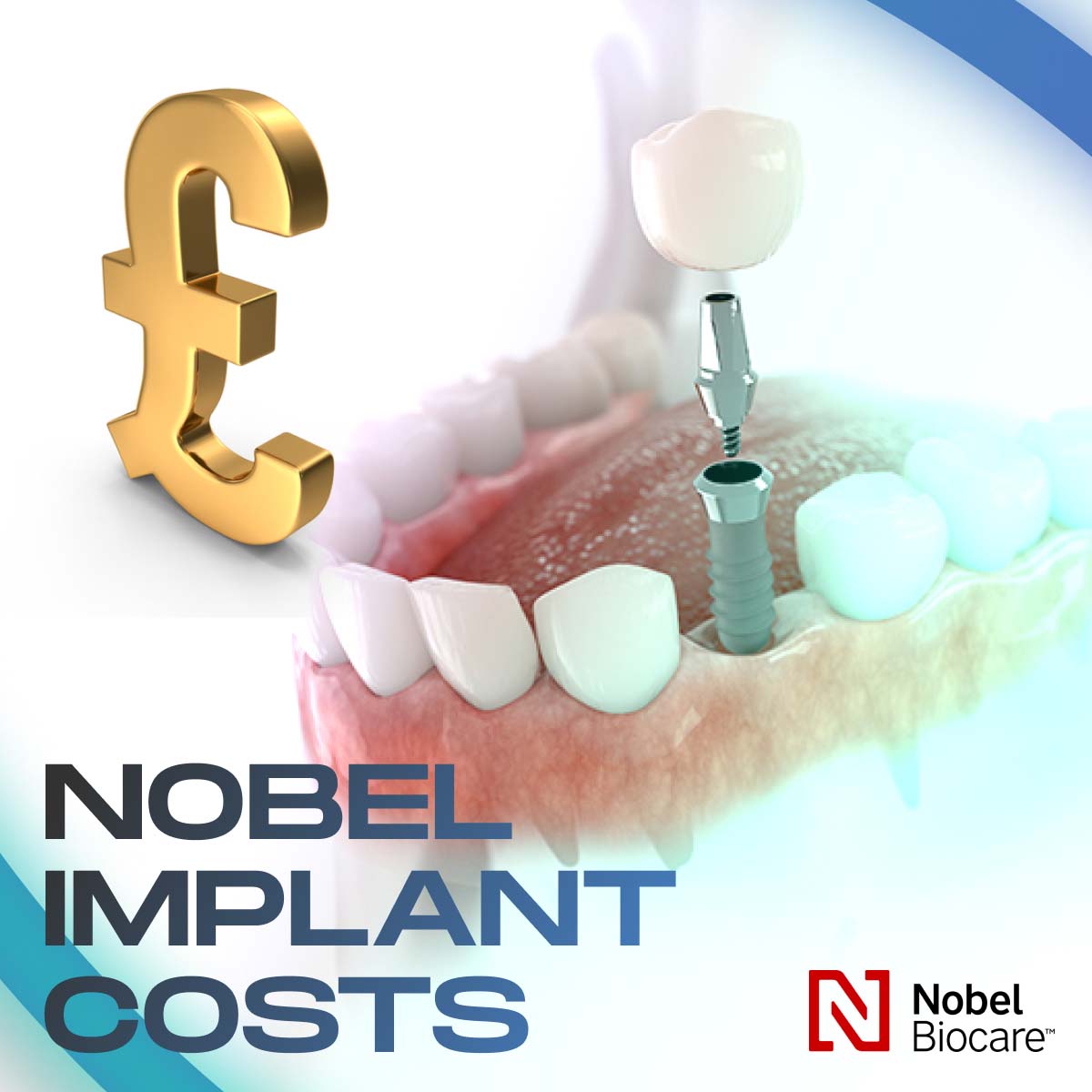 Nobel Brand dental implant cost