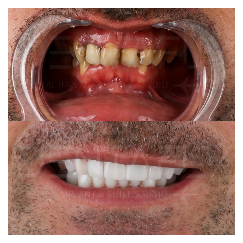 full mouth reconstruction in Turkey