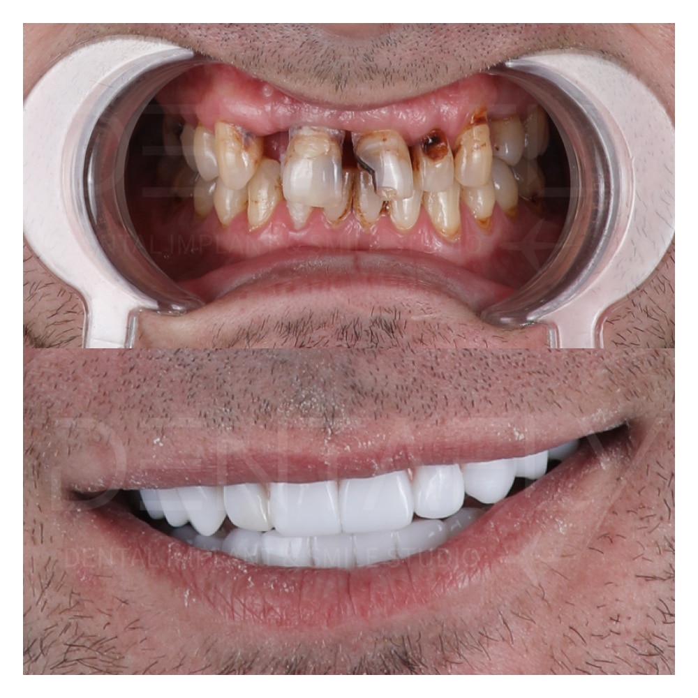 full mouth procedure, frontal zone fixed