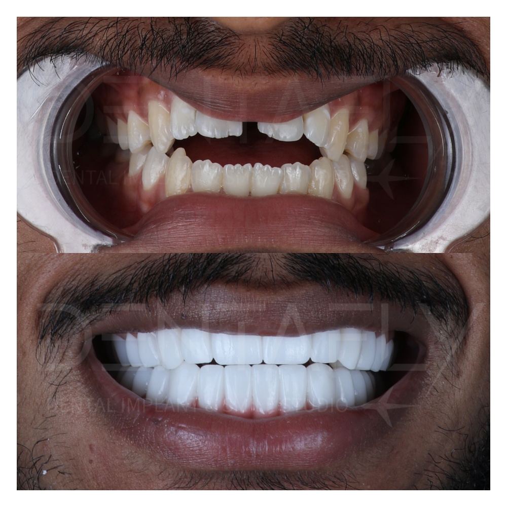 Gum line and frontal line of teeth fixed