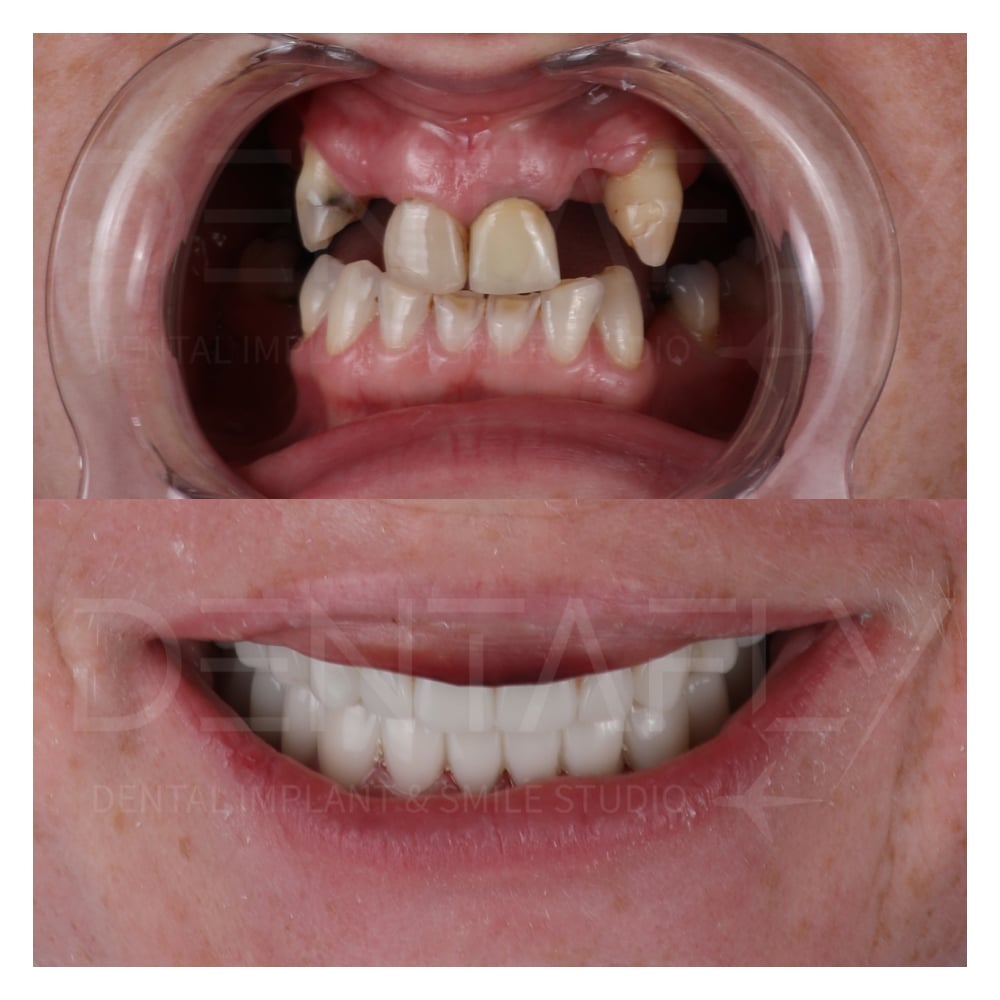 Gum Treatment + Dental Implants + Dental hygiene + Zirconia Crowns