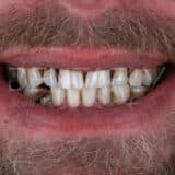 crooked and missing teeth view