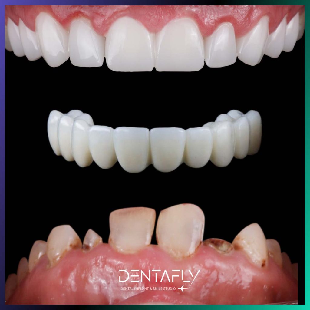 Full set of teeth Turkey cost – Dentafly Dental Clinic