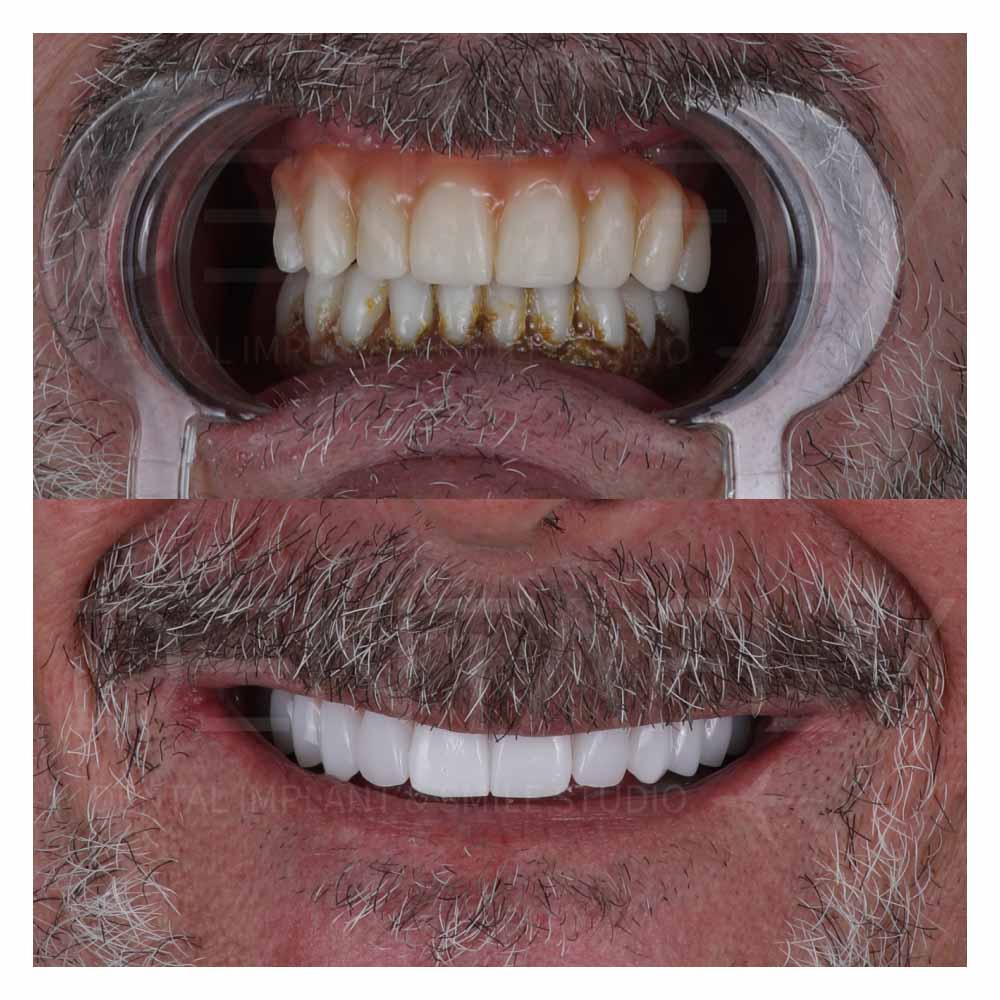 infected bottom side before full mouth dental implants