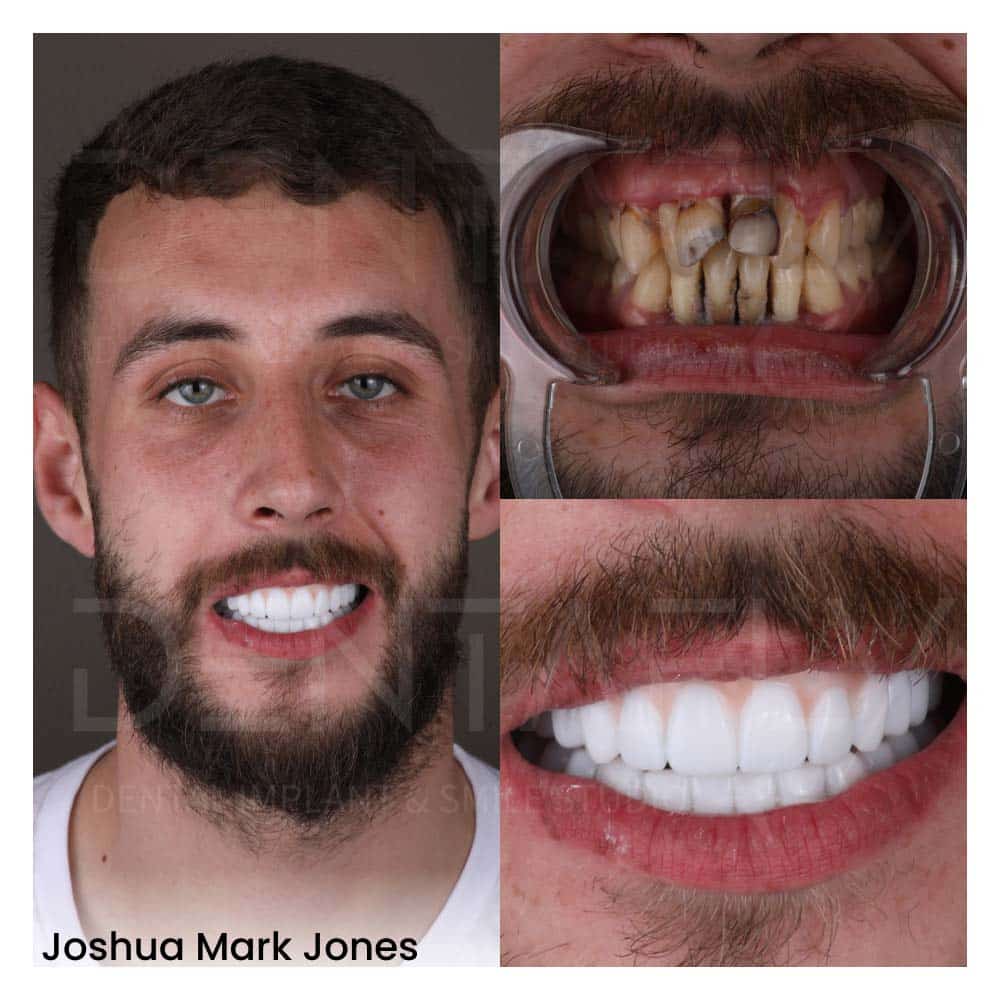 Joshua's new teeth in 3 days