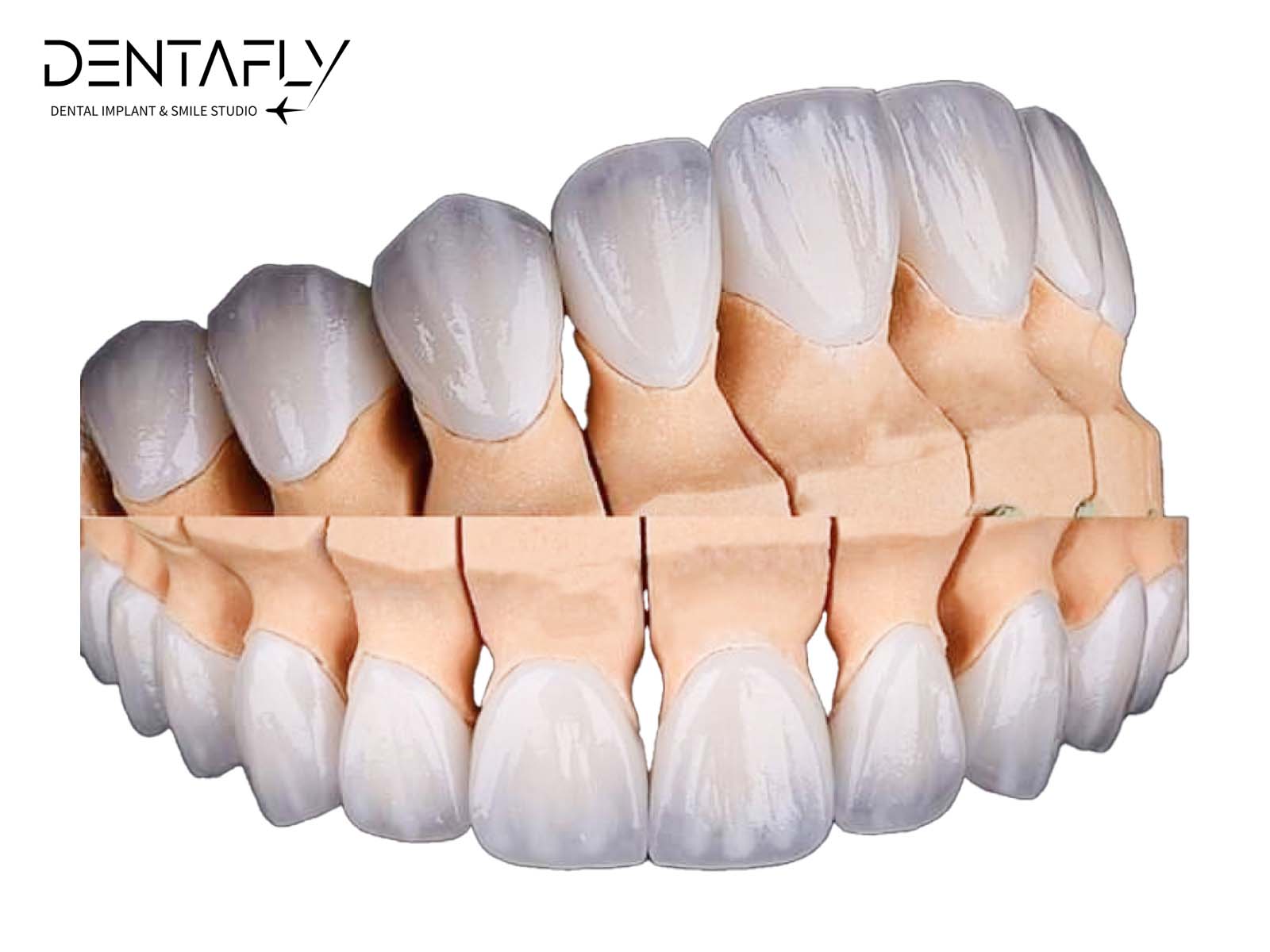 Full set of dental veneers simulation view 
