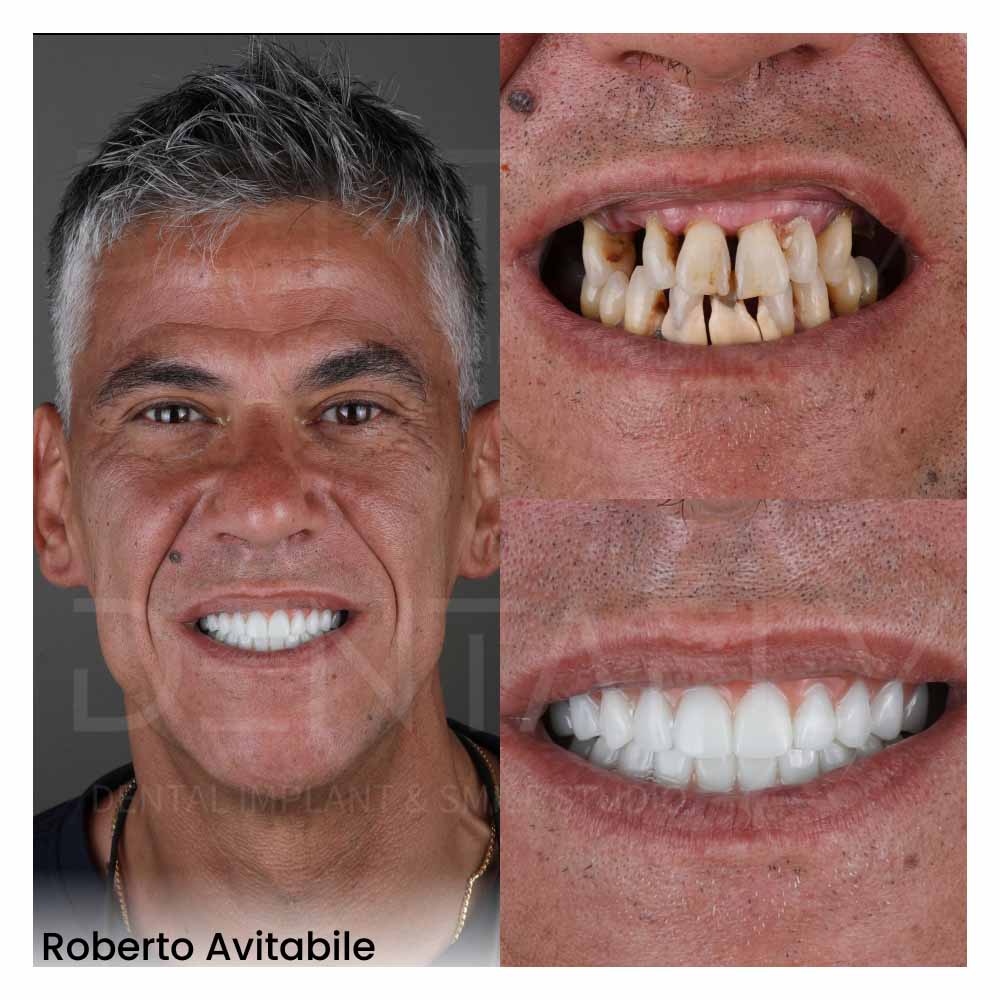 Mr. Roberto preferred Dentafly for crooked teeth