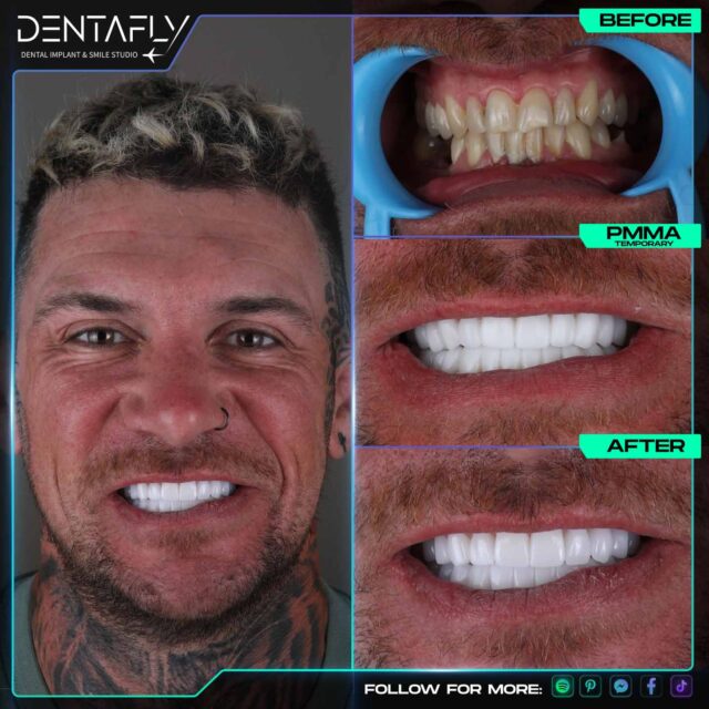 Simon Luke - Dental implant patient of dentafly dental clinic