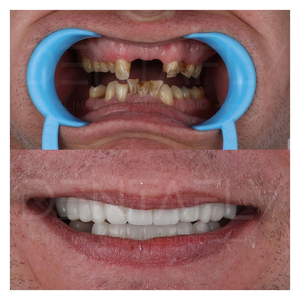 upper-frontal-missing-implants