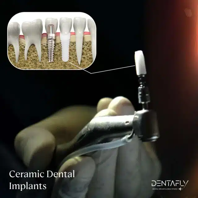 Ceramic Dental Implants