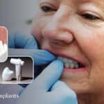 Advantages of Ceramic Dental Implants