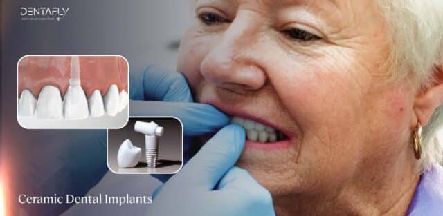 Advantages of Ceramic Dental Implants