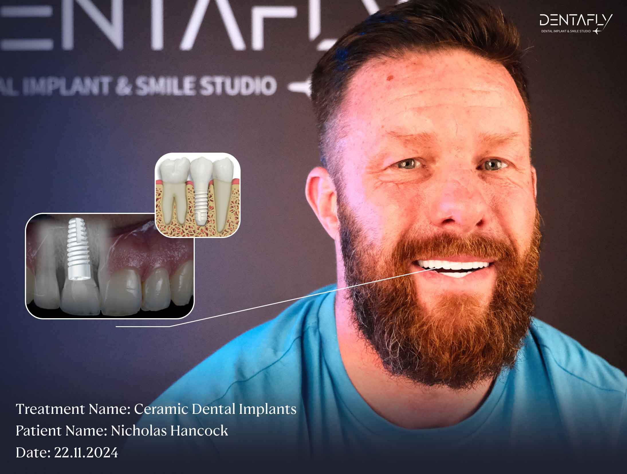 Ceramic Dental Implants 