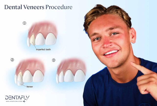 Laminate Veneers in Turkey