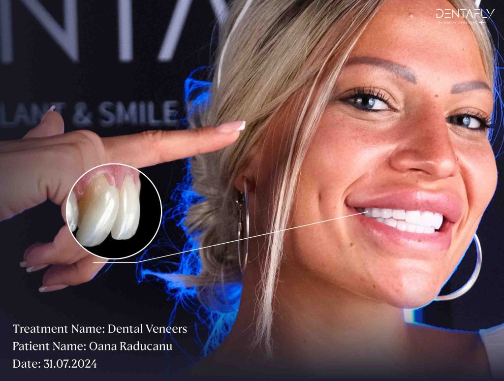 A Complete Guide to Laminate Veneers: Achieve the Perfect Smile with DentaFly