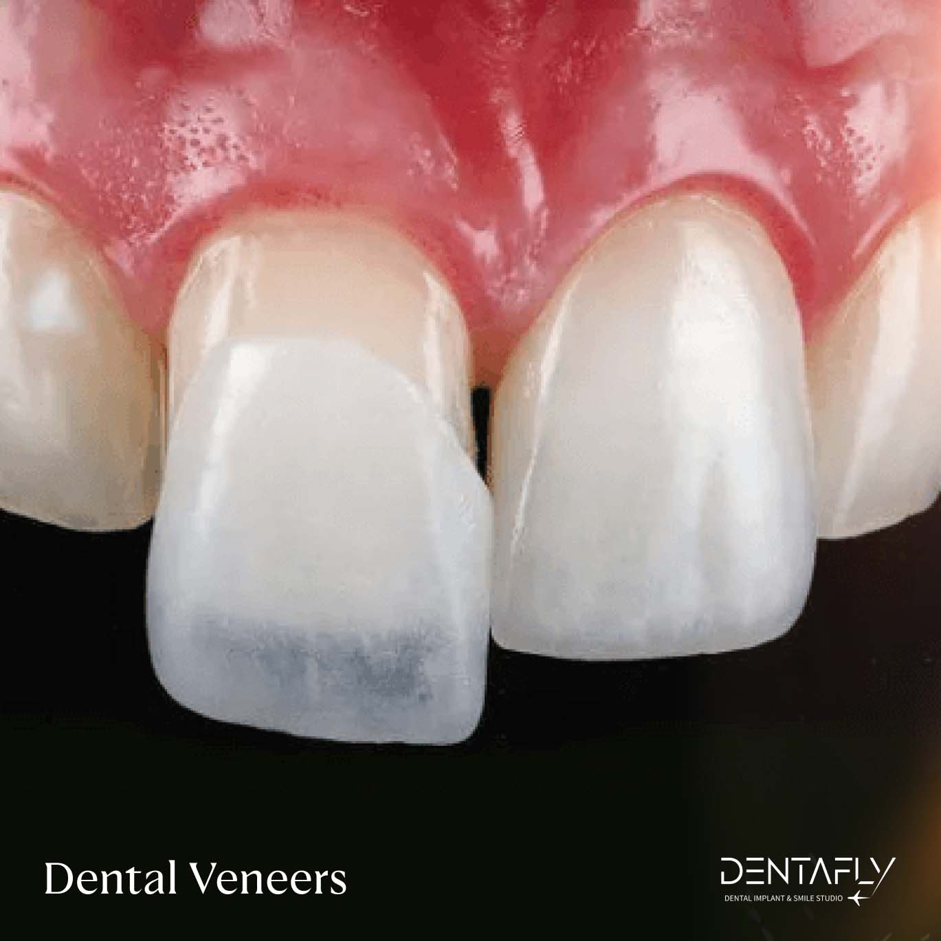 Dental Veneers