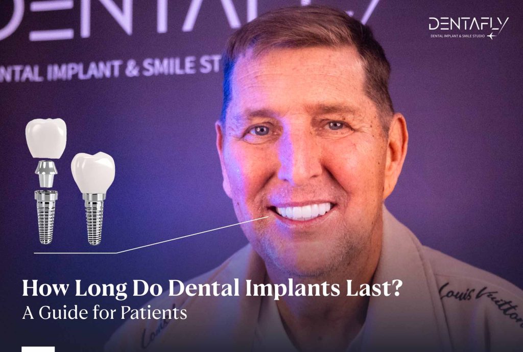 How Long Do Dental Implants Last? A Guide for Patients