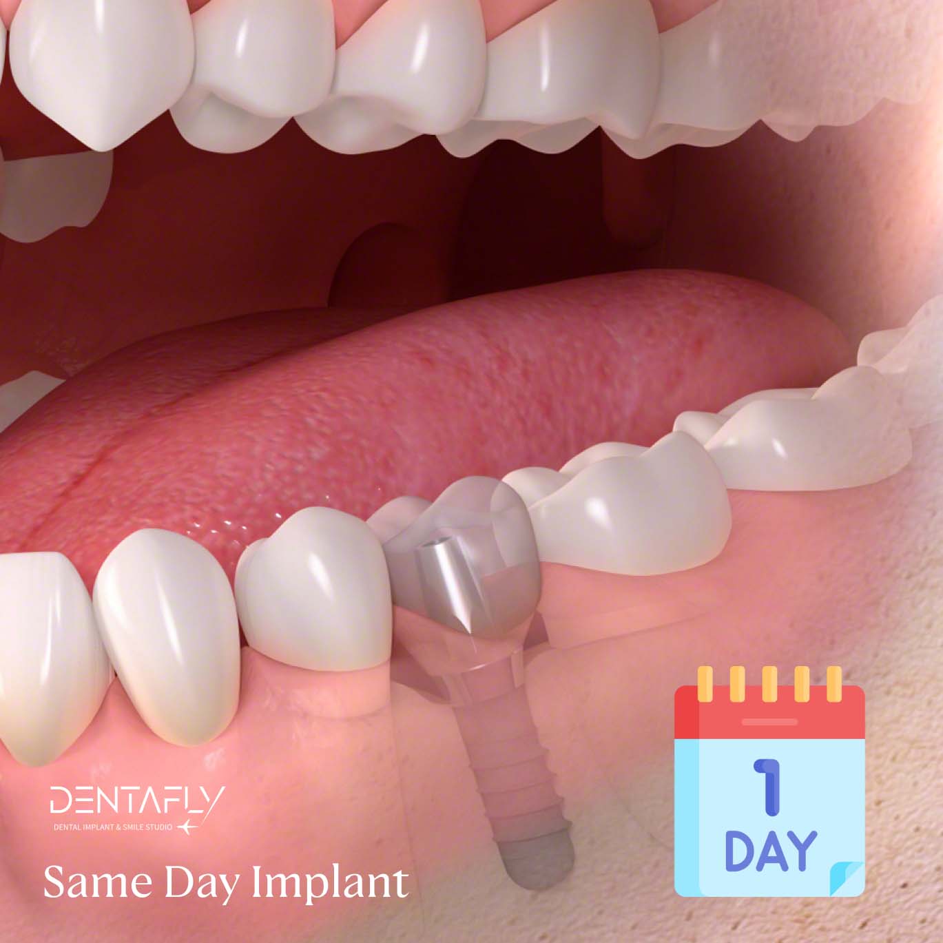 Same Day Dental Implant