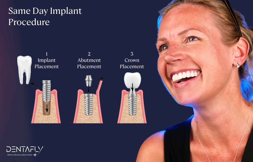 Same Day Dental Implants in Turkey- A Complete Guide to Costs and Procedure