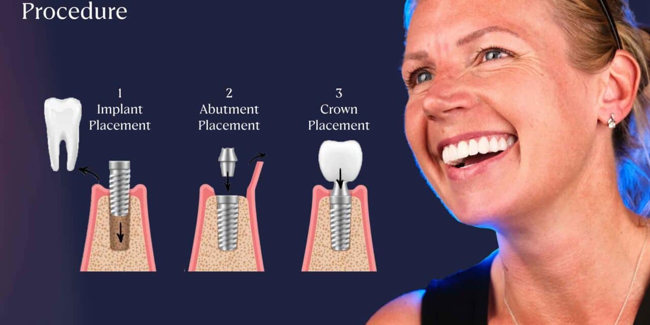 Same Day Dental Implants in Turkey- A Complete Guide to Costs and Procedure