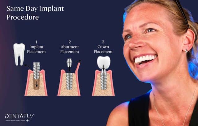 same day implant procedure