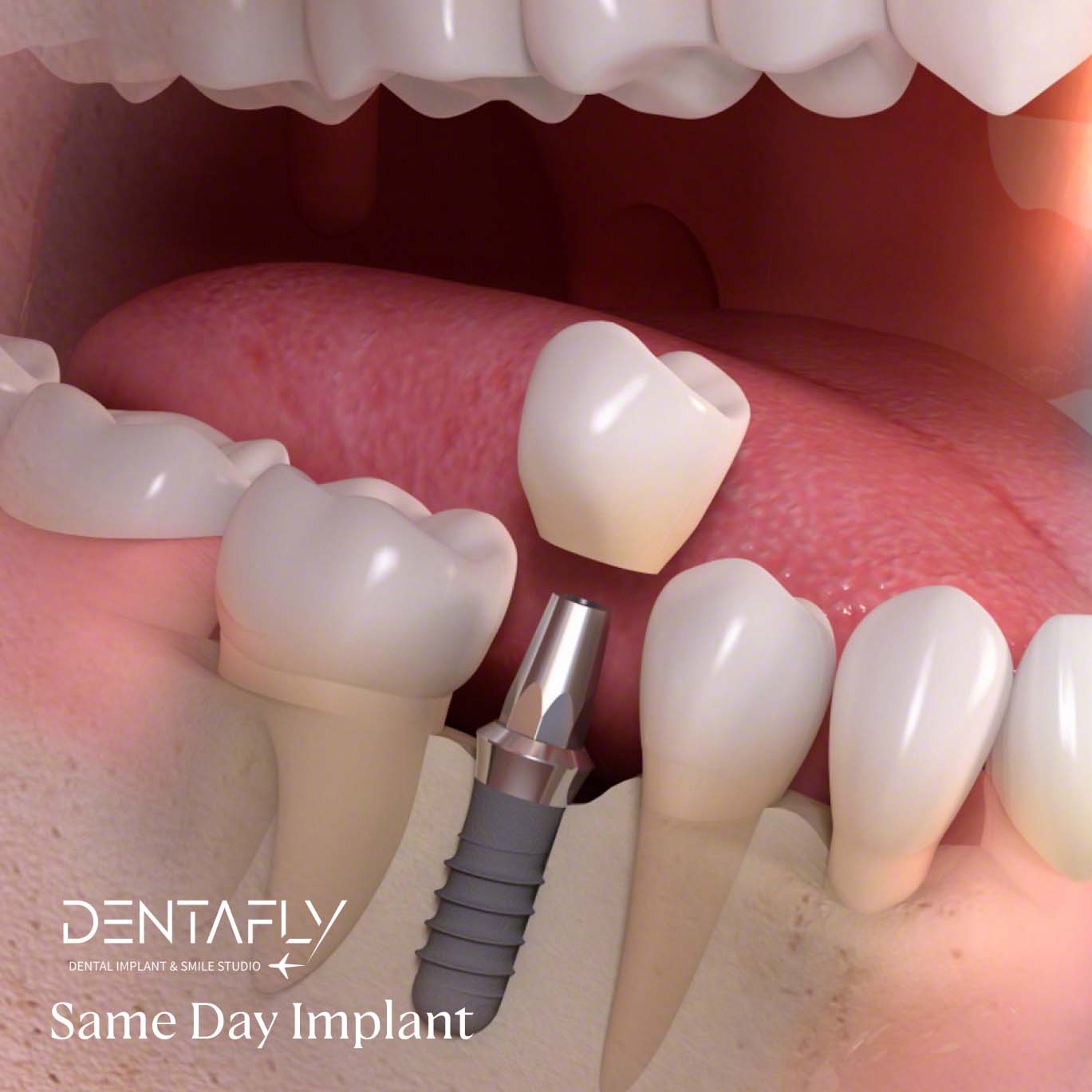 Same Day Dental Implant Procedure