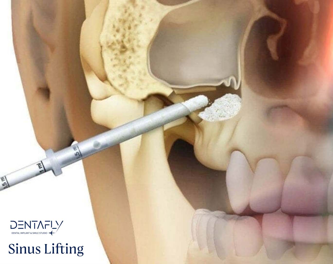 Sinus Lifting