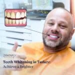 teeth-whitening-in-turkey-1