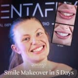smile makeover in 5 days