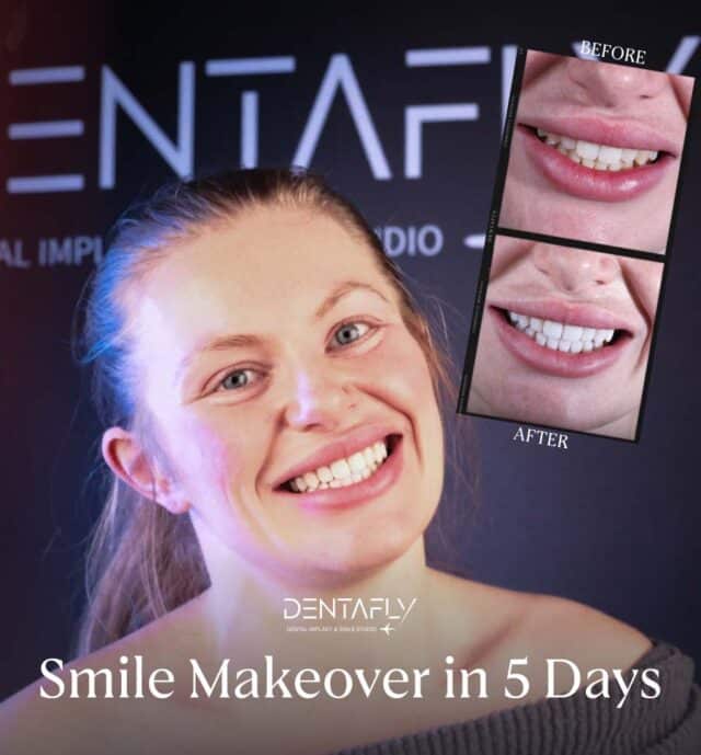 smile makeover in 5 days