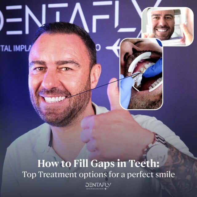 How to Fill Gaps in Teeth