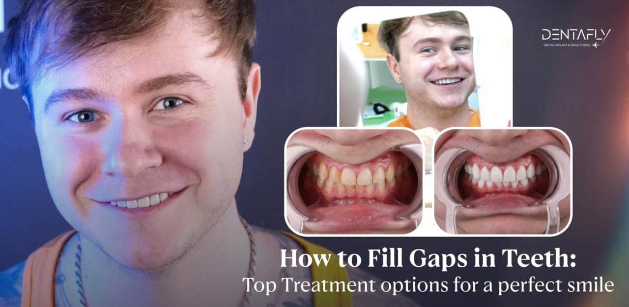 How to Fill Gaps in Teeth