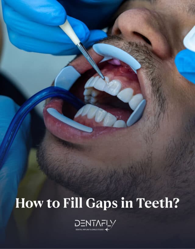 Dental Implants to Fill Gaps in Teeth