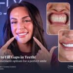 how-to-fill-gaps-in-teeth-4